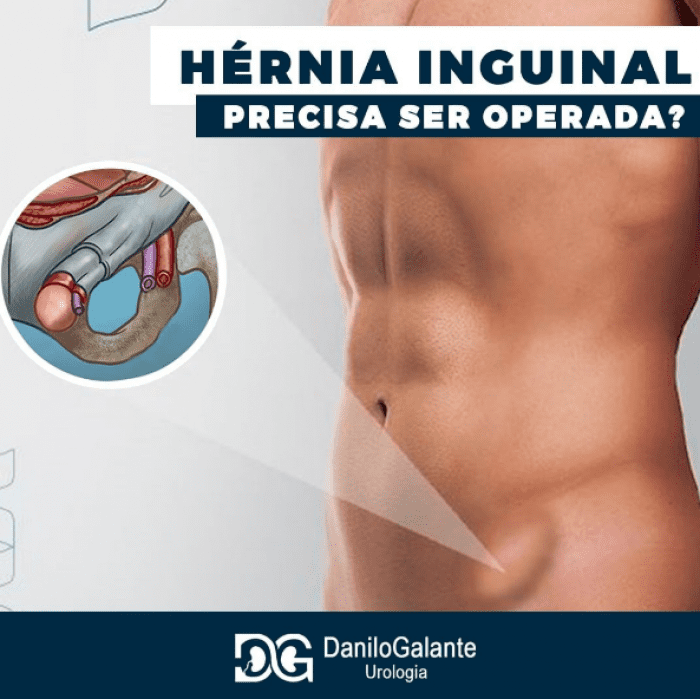 Hérnia Inguinal - precisa ser operada?