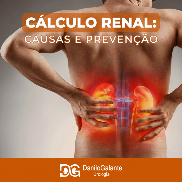 Cálculo Renal - causas e prevenção