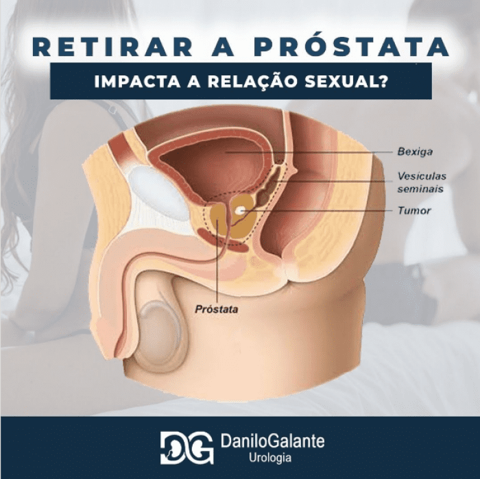 Retirar a próstata impacta a relação sexual?