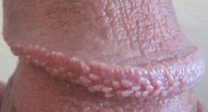 Imagen  Glândulas de Tyson (cabeça do pênis)
