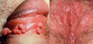 lesões por HPV