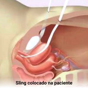 Sling colocado na paciente