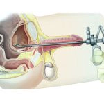 visão da bexiga ( Cistoscopia normal )