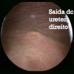 visão da bexiga ( Cistoscopia normal )