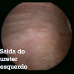 visão da bexiga ( Cistoscopia normal )