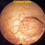 visão da bexiga ( Cistoscopia normal )