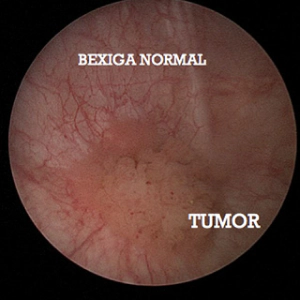 RESSECÇÃO TRANS URETRAL DA BEXIGA