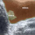 USG de bexiga com tumor