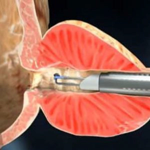 Ressecção Trans Uretral (RTU) da Prostata – Técnica clássica