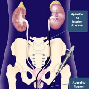 Ureteroscópio flexível em ação