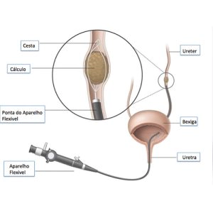 Ureteroscópio flexível em ação