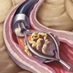 Ureteroscópio flexível em ação