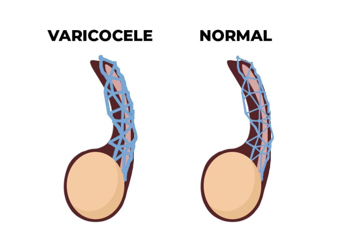 Varicocele