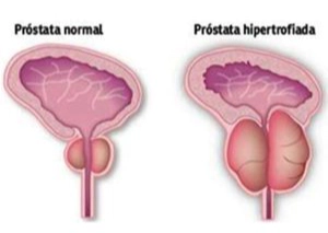 exemplo prostata normal e hipertrofiada